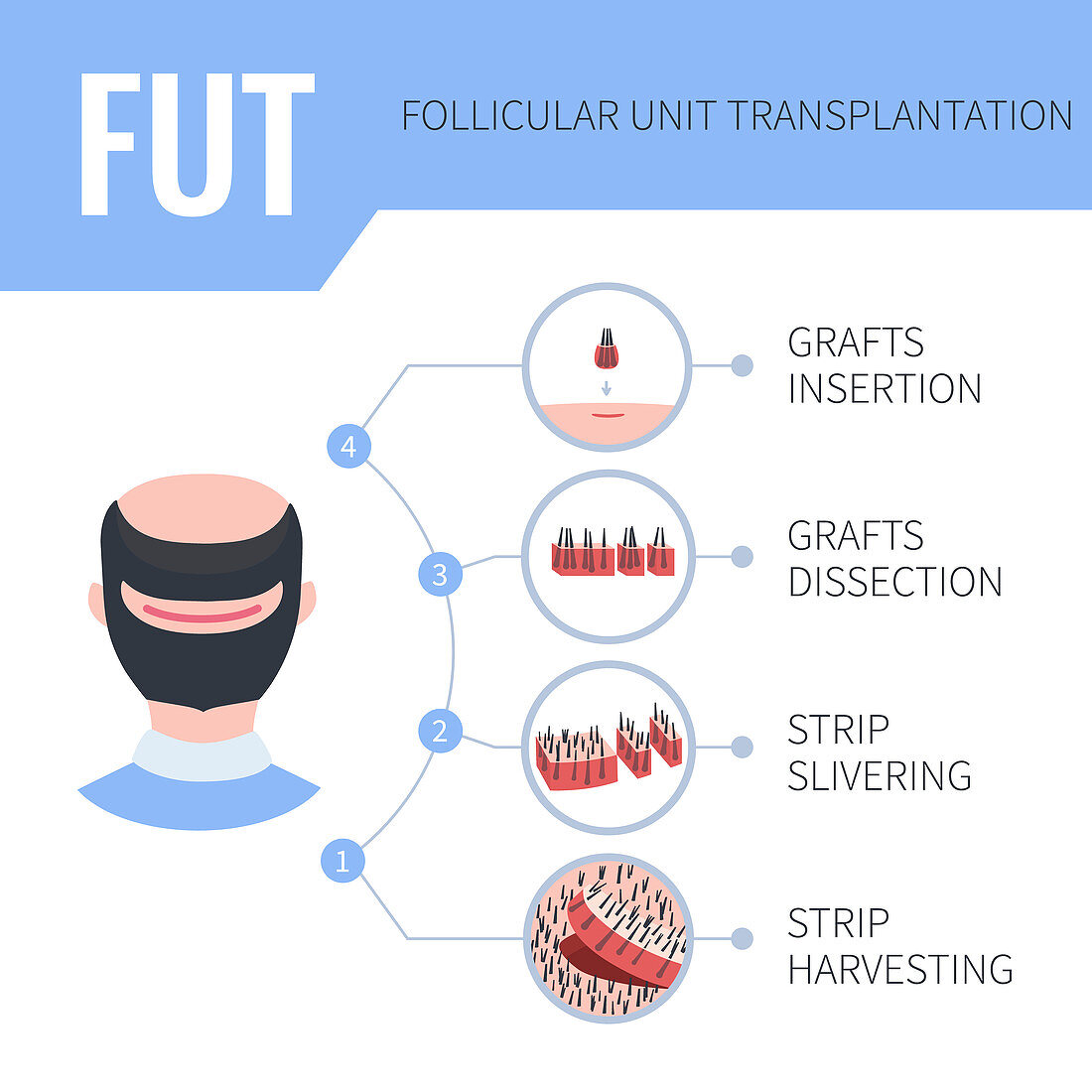 FUT hair transplantation in men, illustration