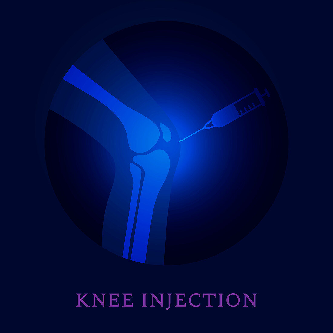 Knee injection, conceptual illustration