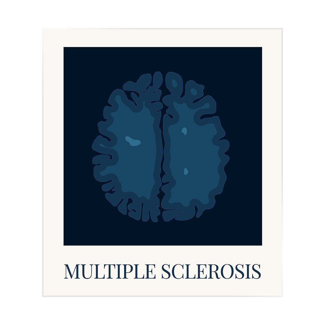 Brain affected by multiple sclerosis, illustration