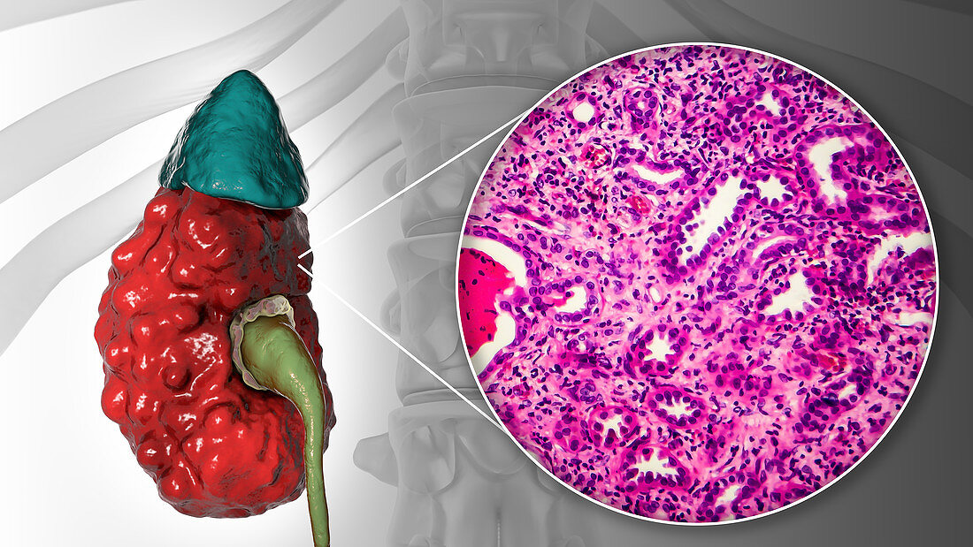 Chronic pyelonephritis, illustration and light micrograph