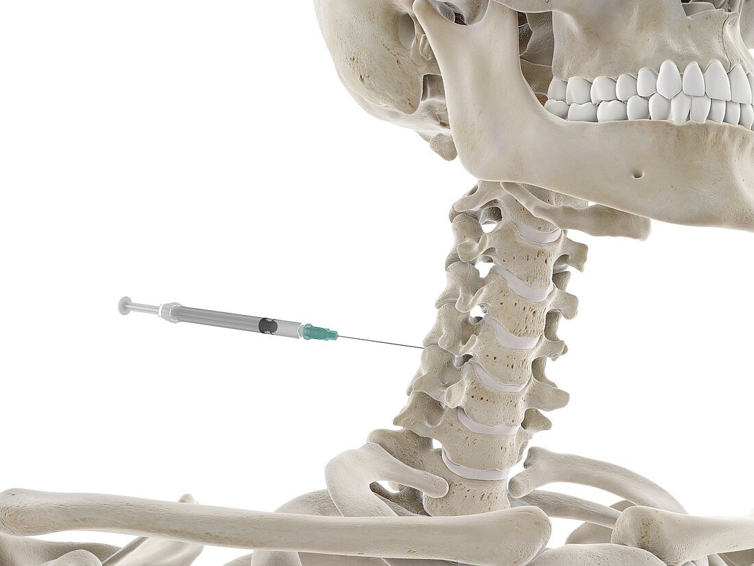 Spine injection, illustration
