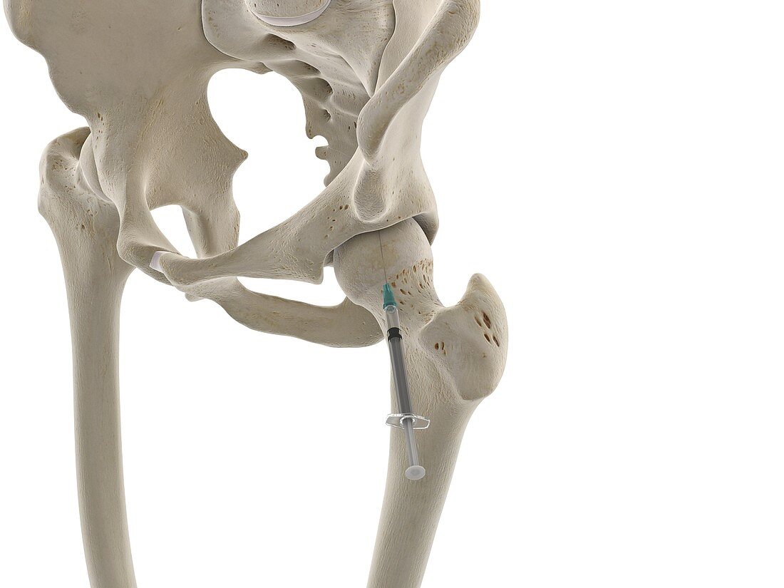 Hip joint injection, illustration