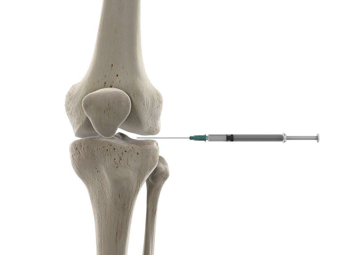 Knee joint injection, illustration