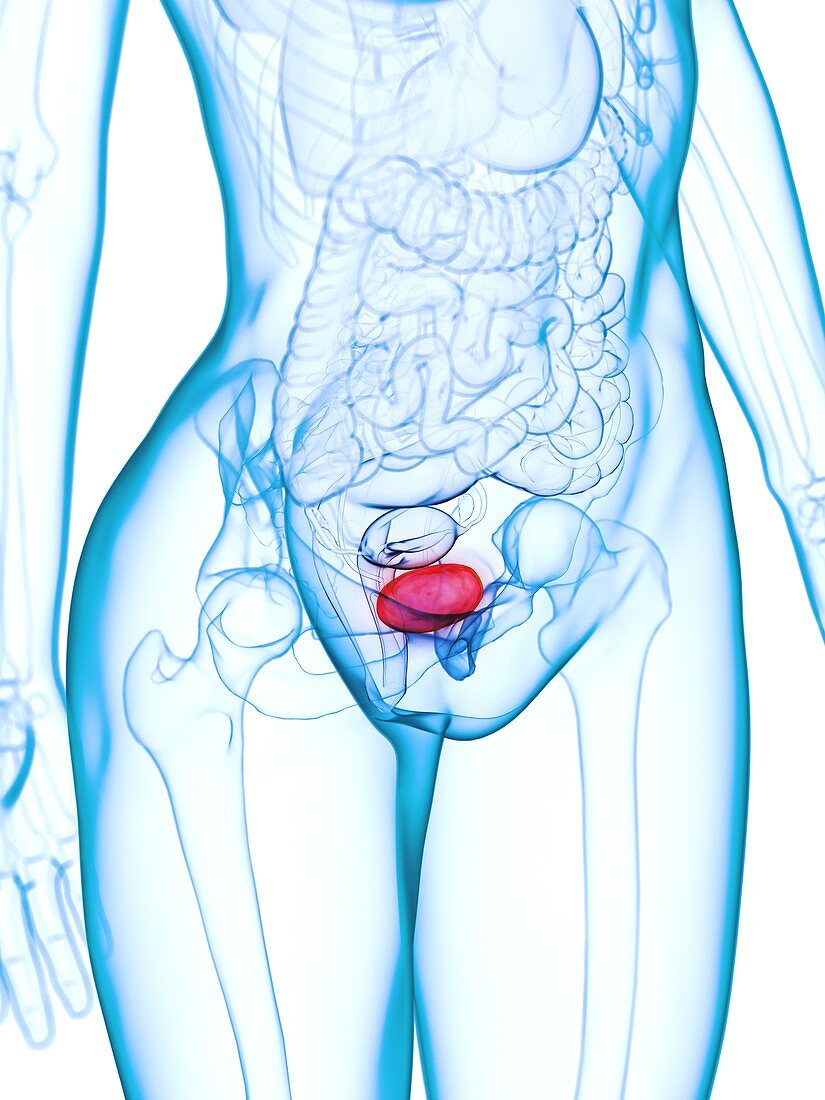 Diseased bladder, illustration