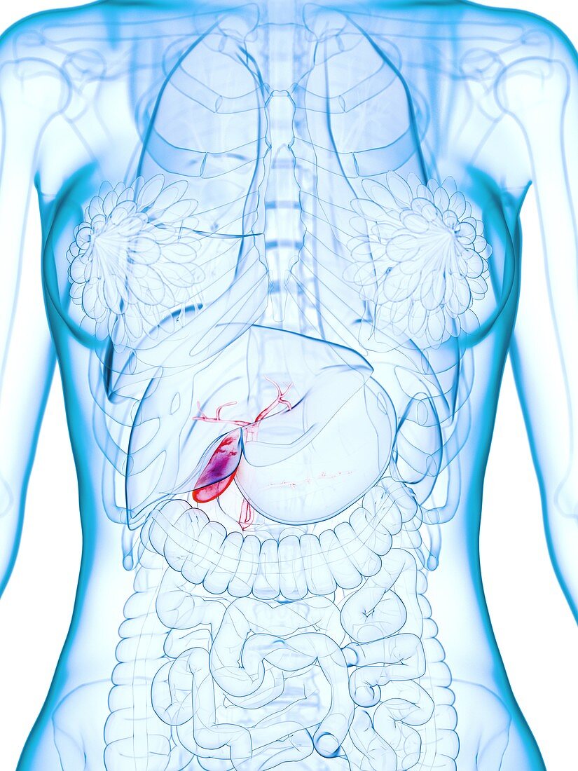Diseased gallbladder, illustration