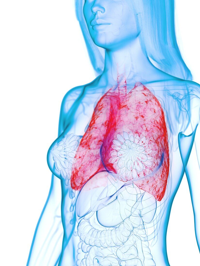 Diseased lung, illustration