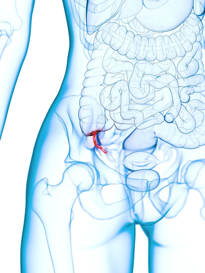 Inflamed appendix, illustration