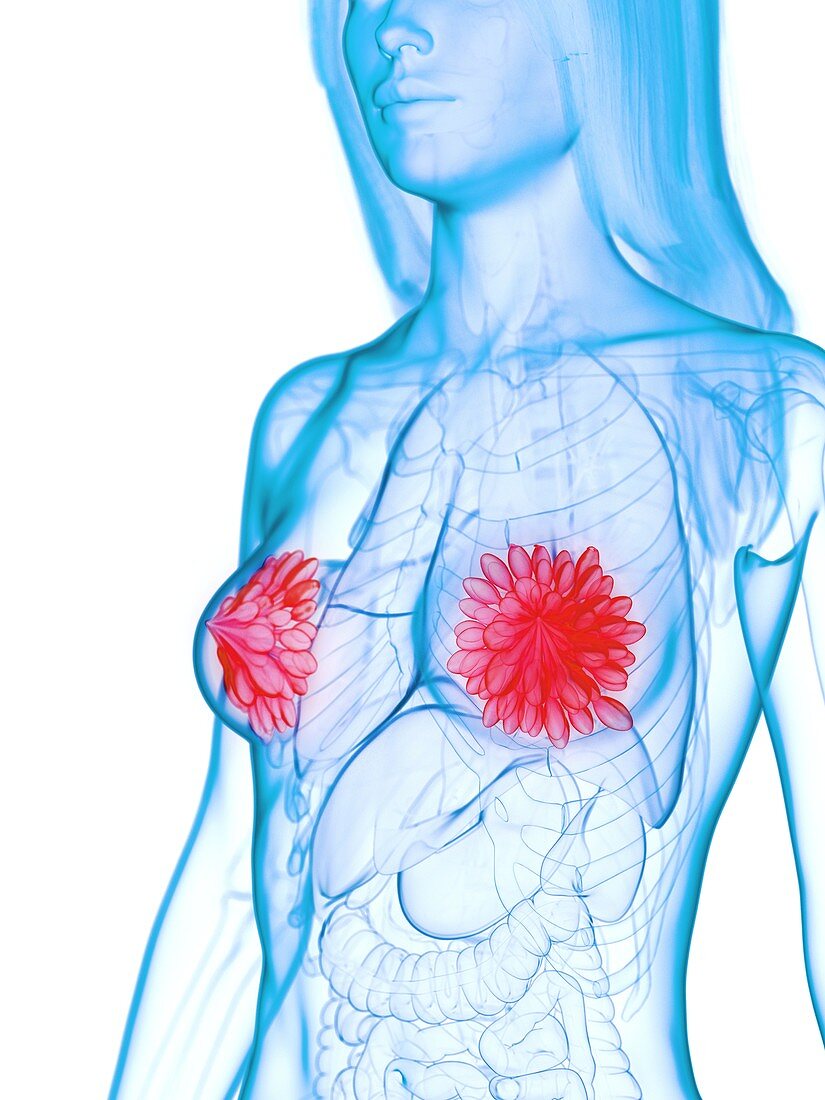 Diseased mammary glands, illustration