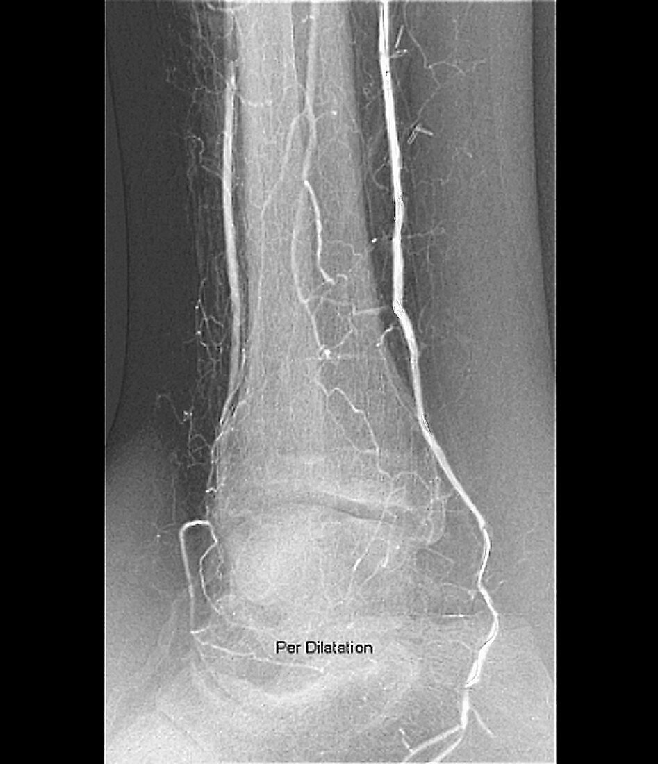 Narrowed leg artery treatment, X-ray