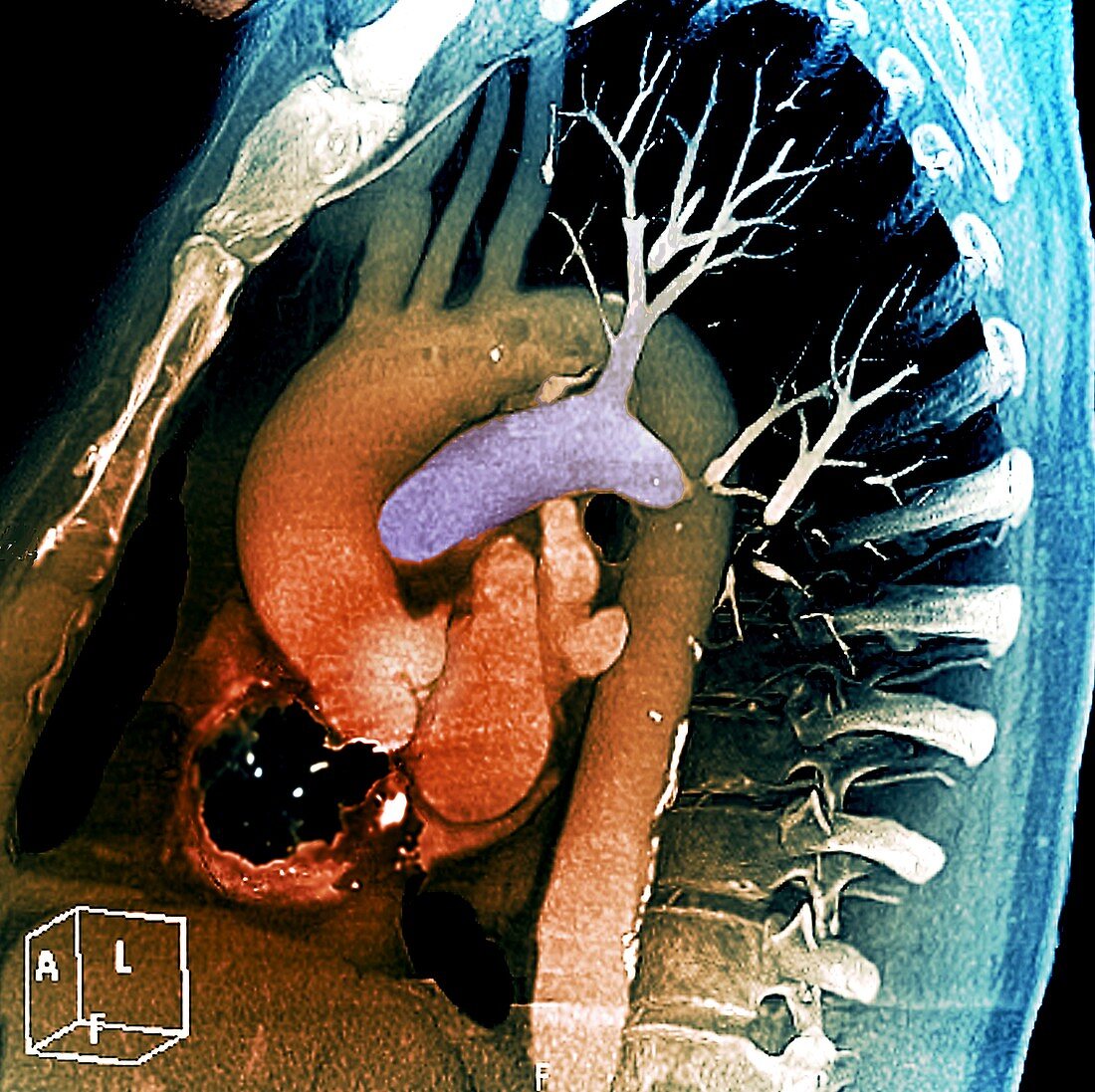 Aortic aneurysm stent, 3D CT scan