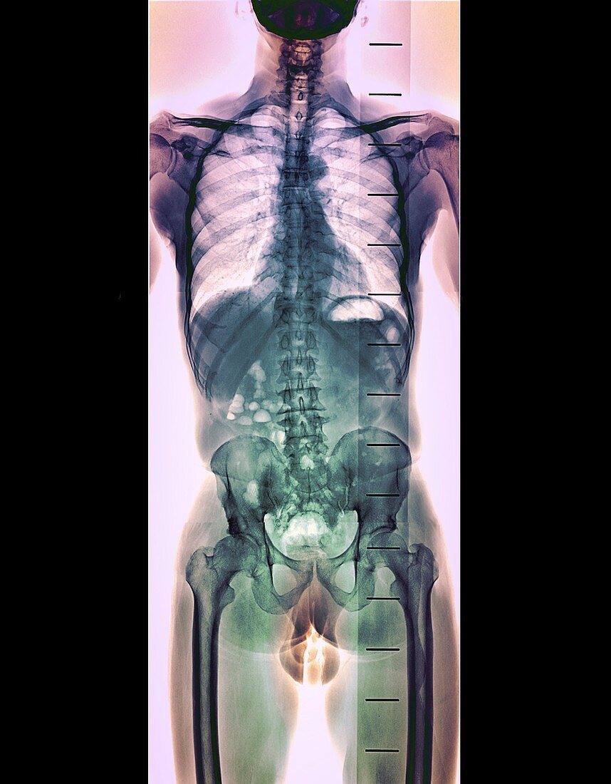 Healthy spine, X-ray