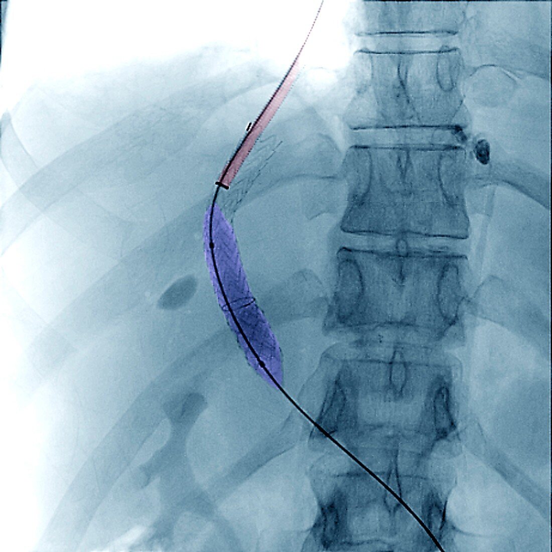 Portal vein surgery, X-ray