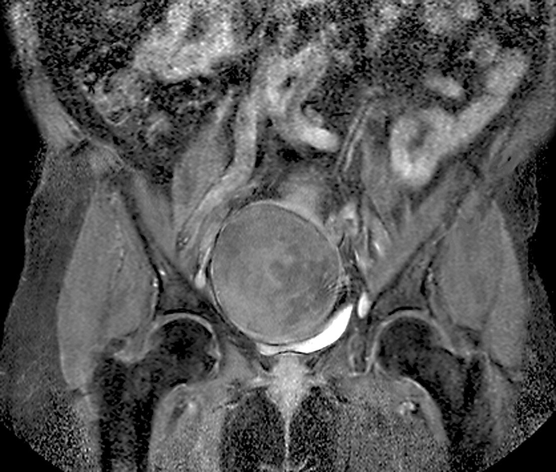 Uterine fibroid, MRI scan