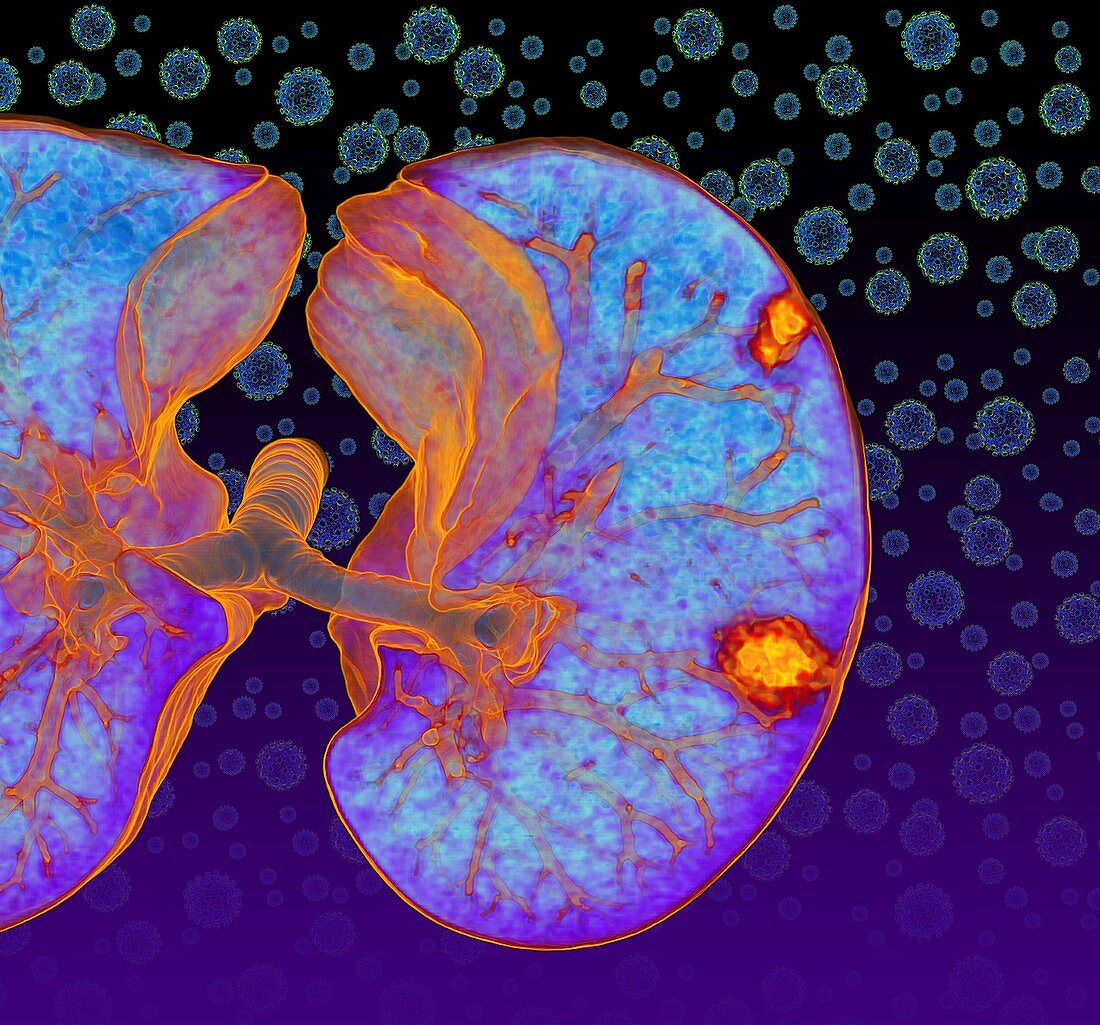 Lungs affected by Covid-19 coronavirus, CT scan and models