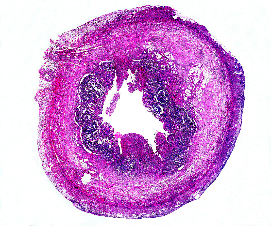 Suppurative appendicitis, light micrograph