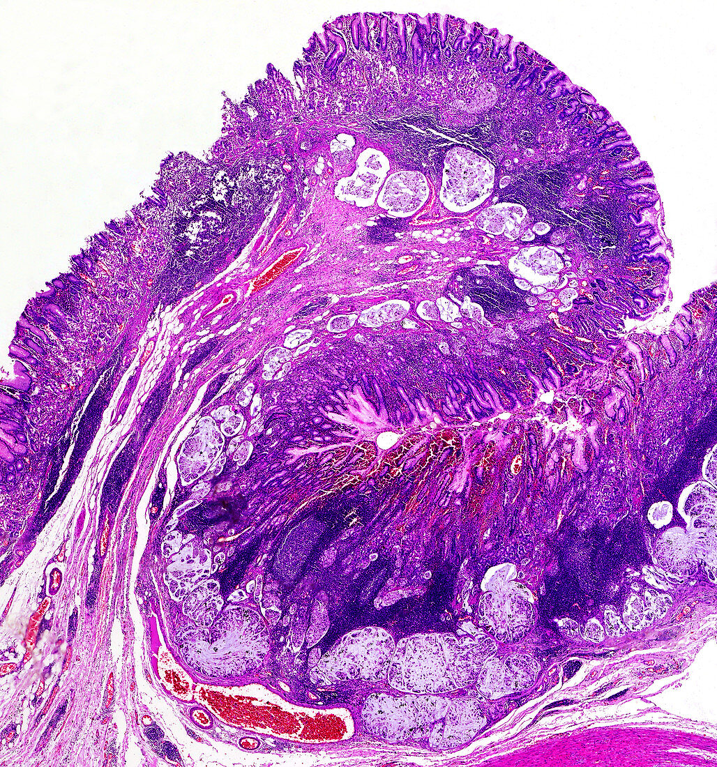 Mutinous carcinoma of the stomach, light micrograph