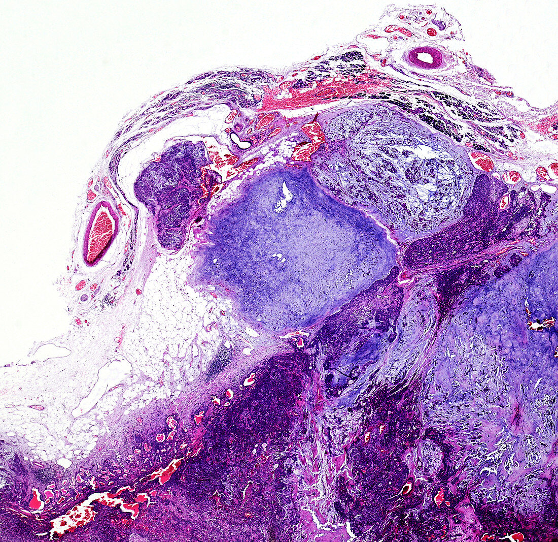 Pleomorphic adenoma of the parotid gland, light micrograph