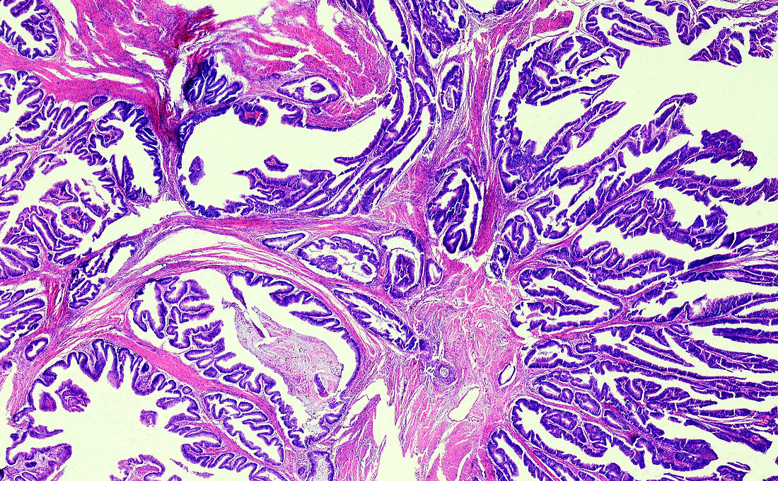 Intestinal adenocarcinoma, light micrograph