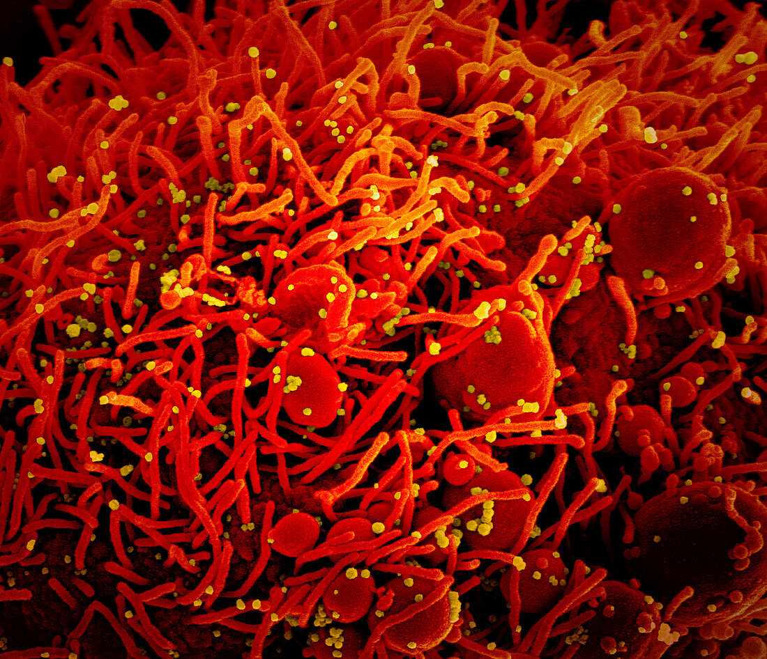 Cell infected with Covid-19 coronavirus particles, SEM