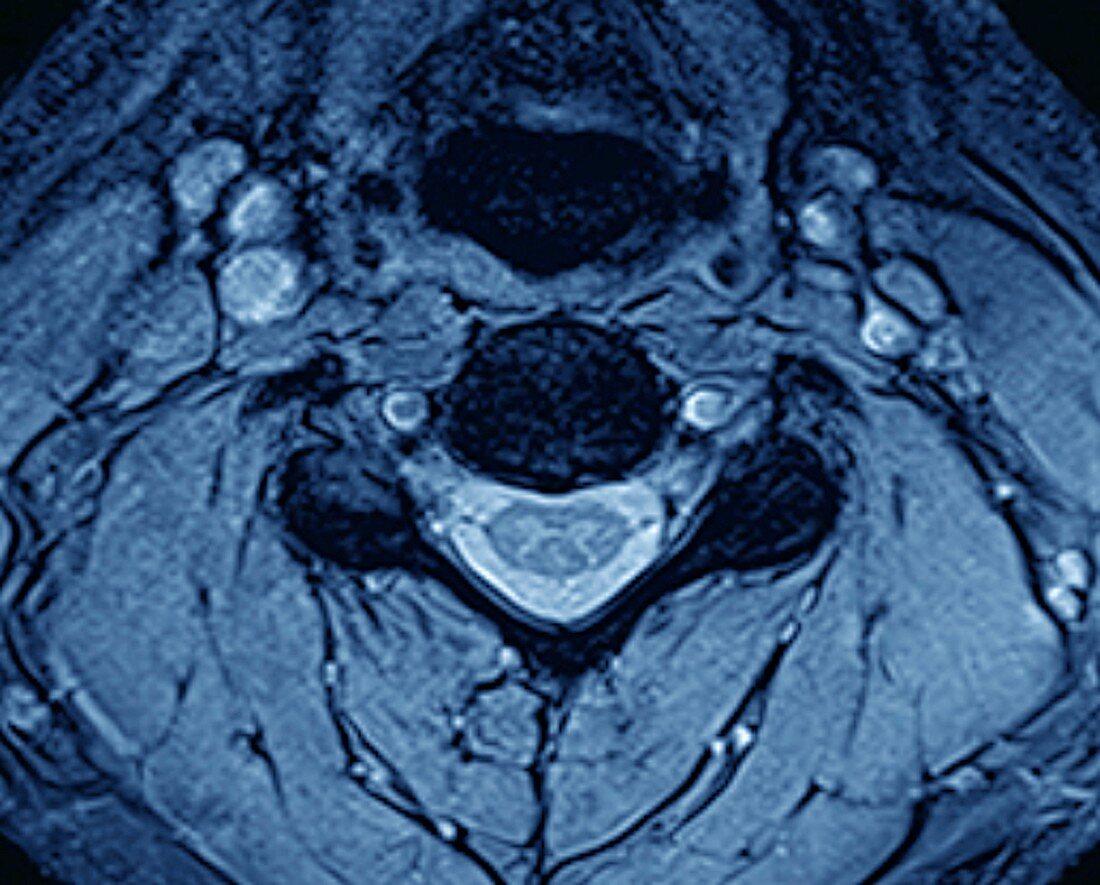 Vertebra and spinal cord, MRI scan