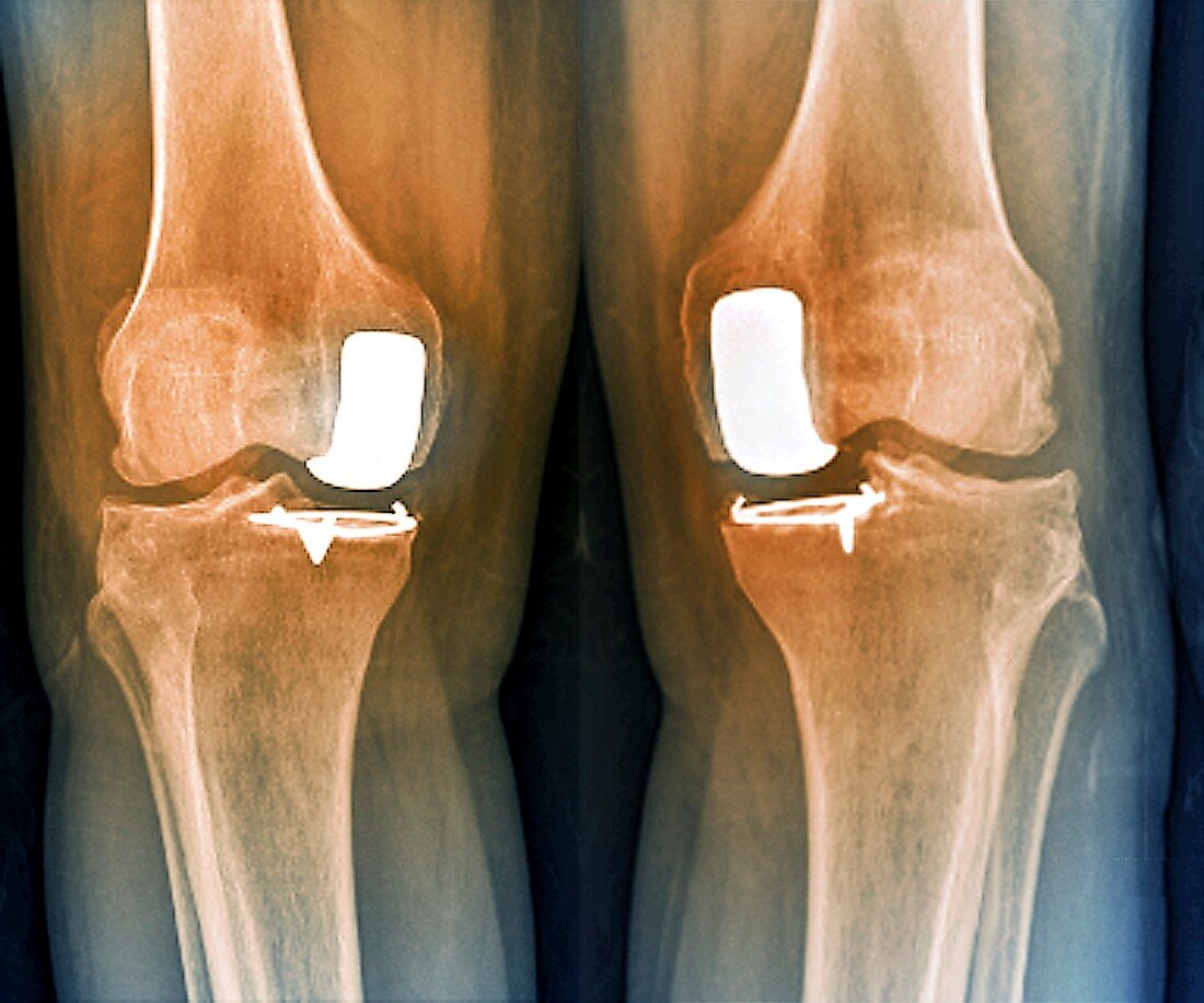 Partial knee replacement, X-ray