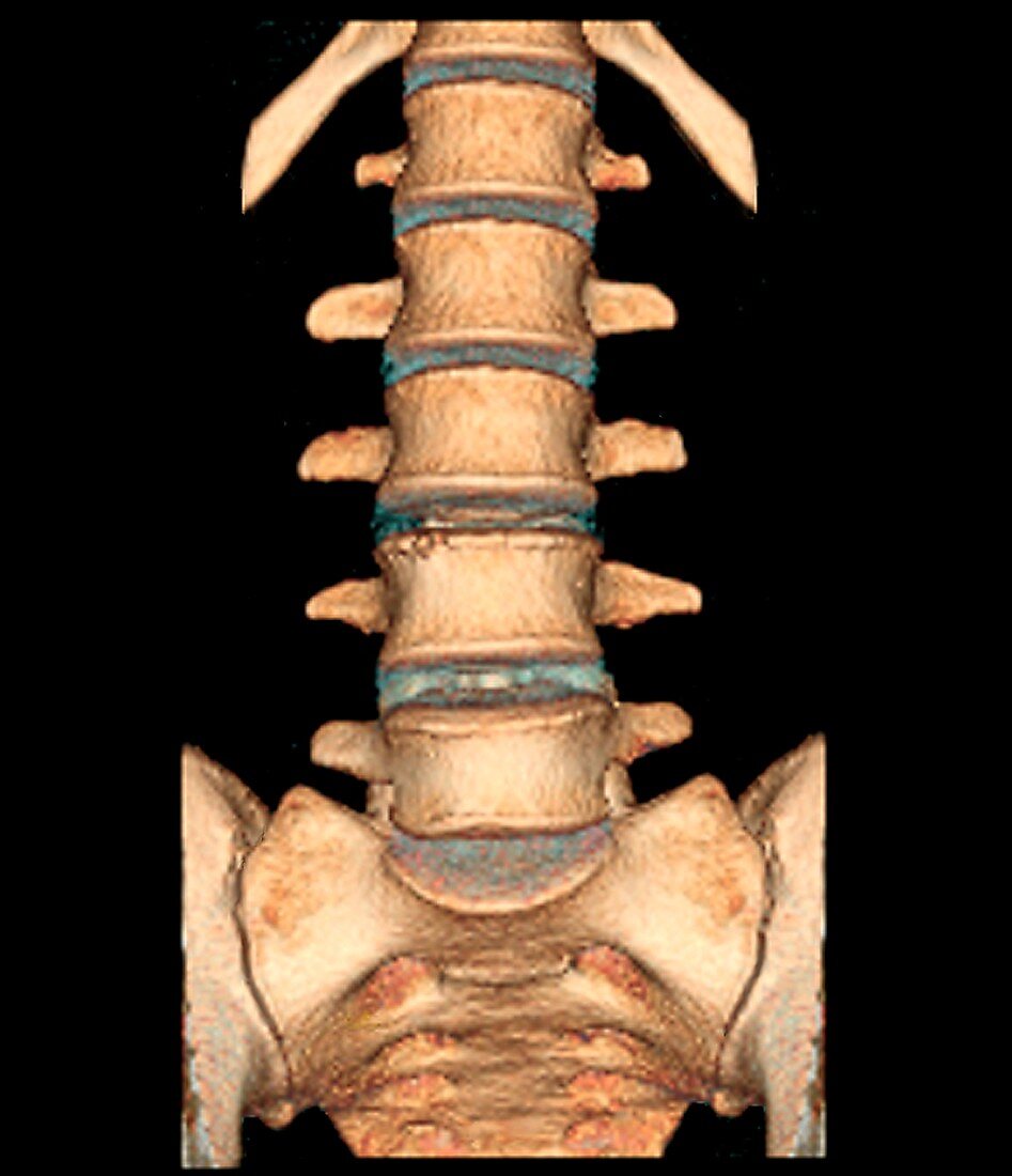 Healthy lower spine, 3D CT scan