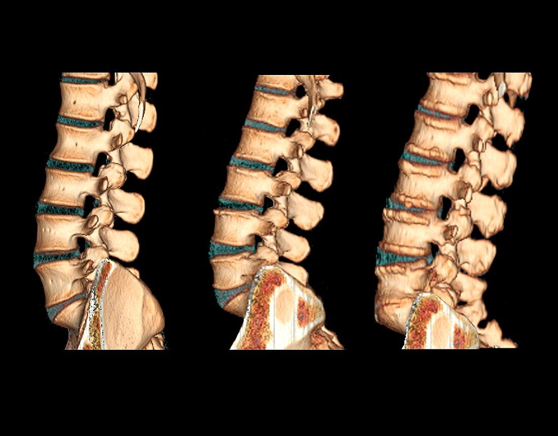 Spine at different ages, 3D CT scans