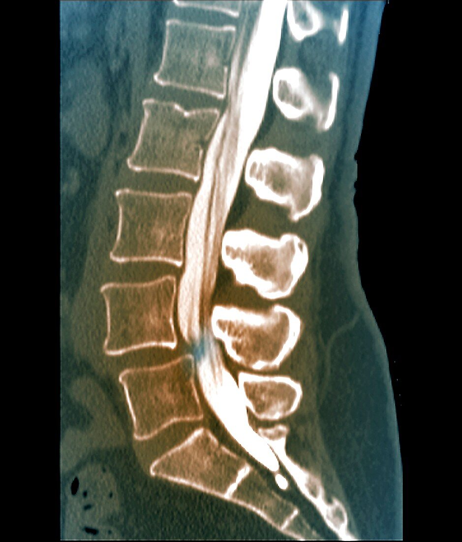 Herniated disc, CT scan