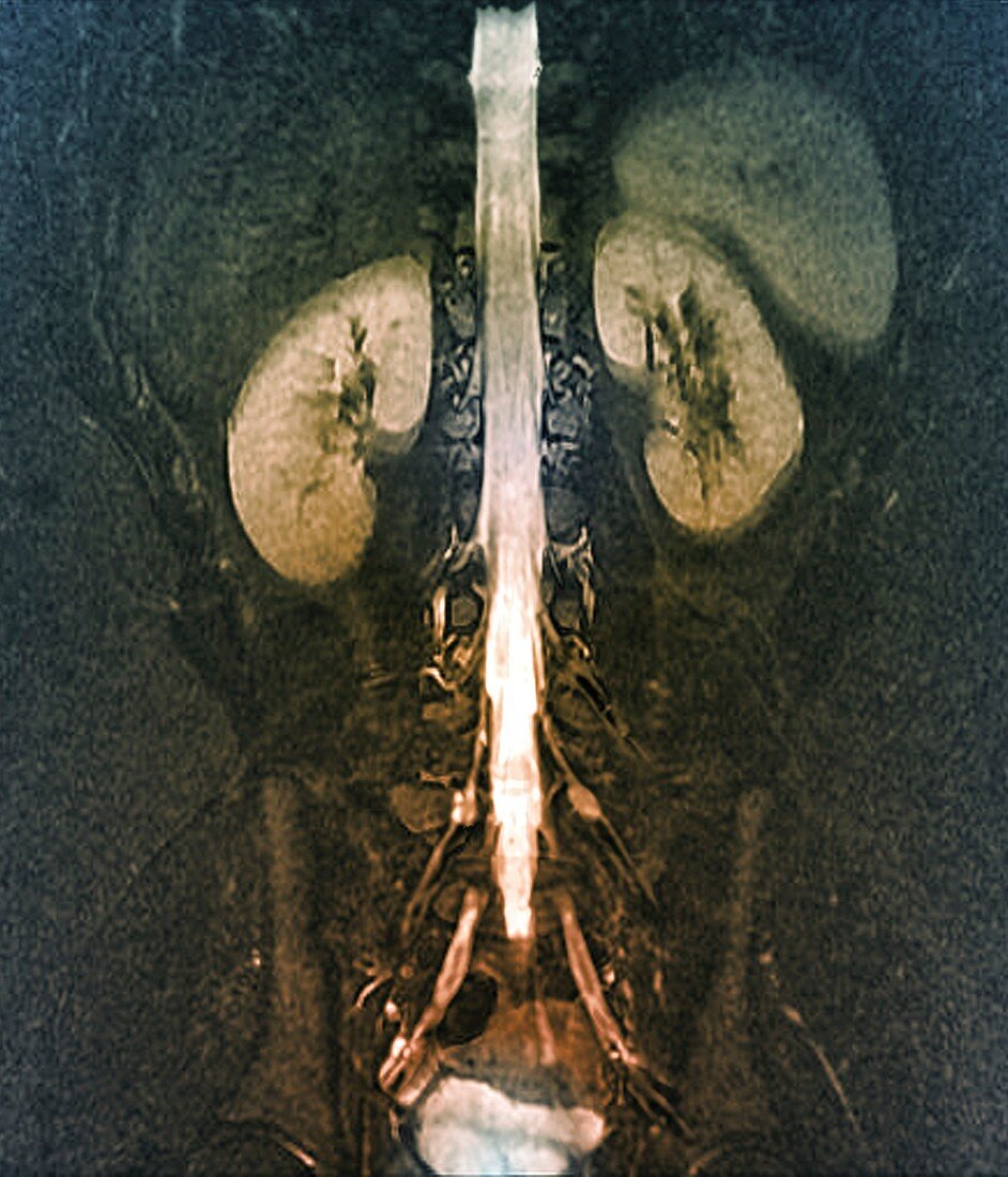 Tarlov spinal cysts, MRI scan