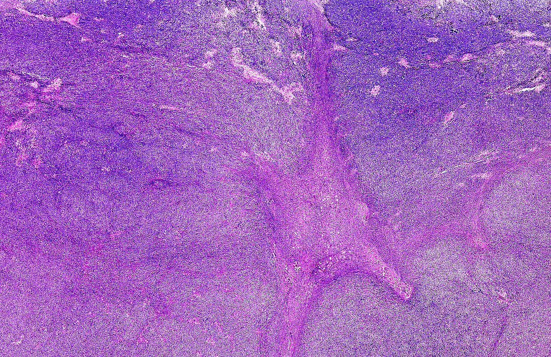 Human testicular seminoma, light micrograph