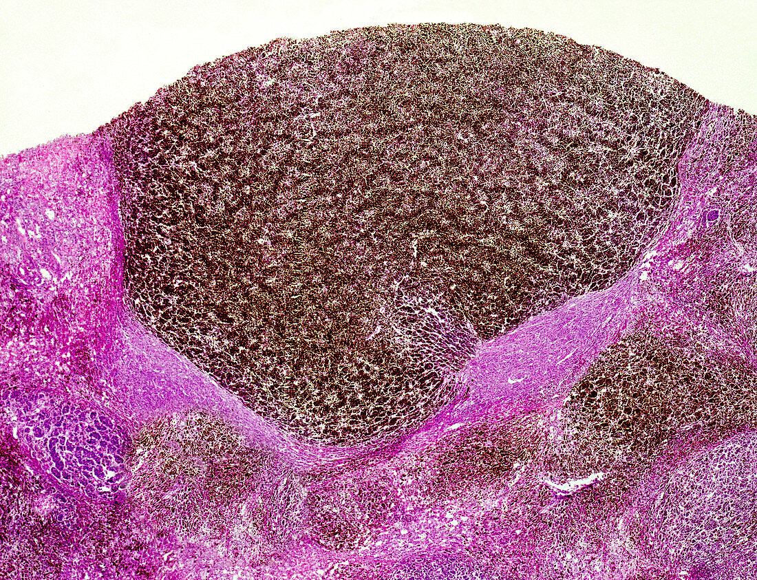Malignant melanoma of the human liver, light micrograph
