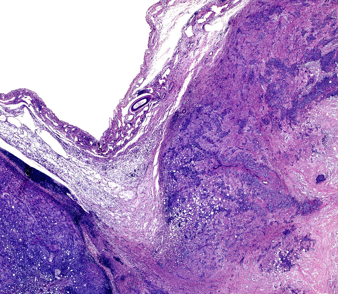Glomerular nephritis, light micrograph