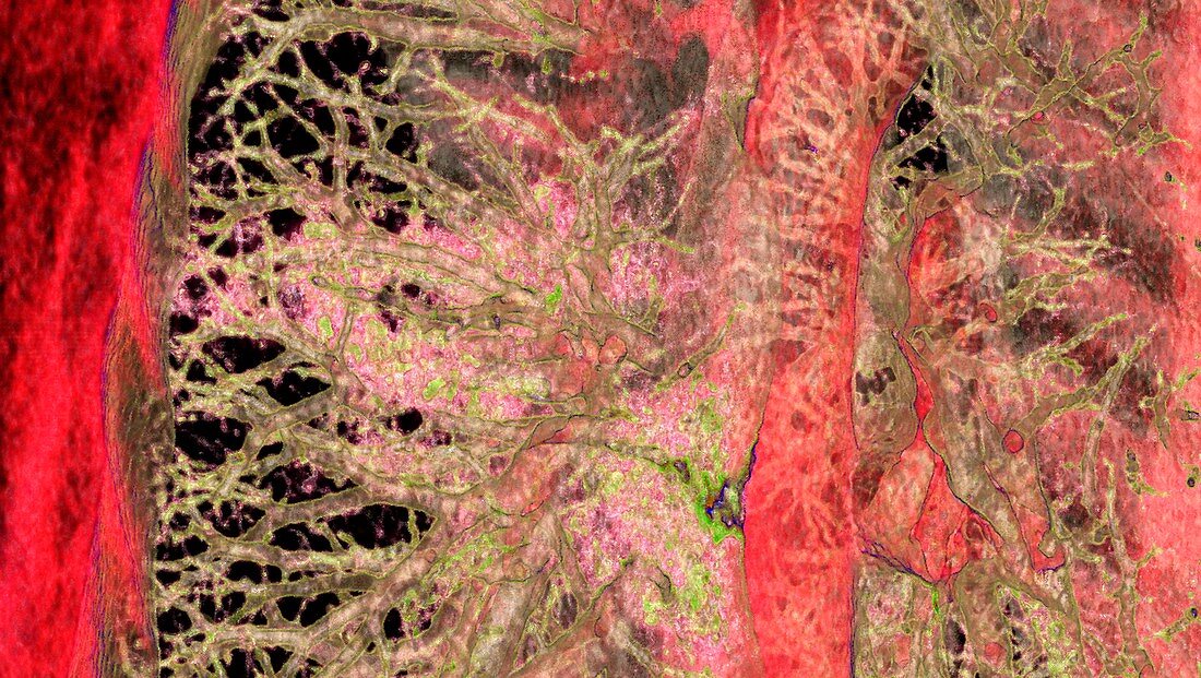 Lungs affected by Covid-19 pneumonia, CT scan