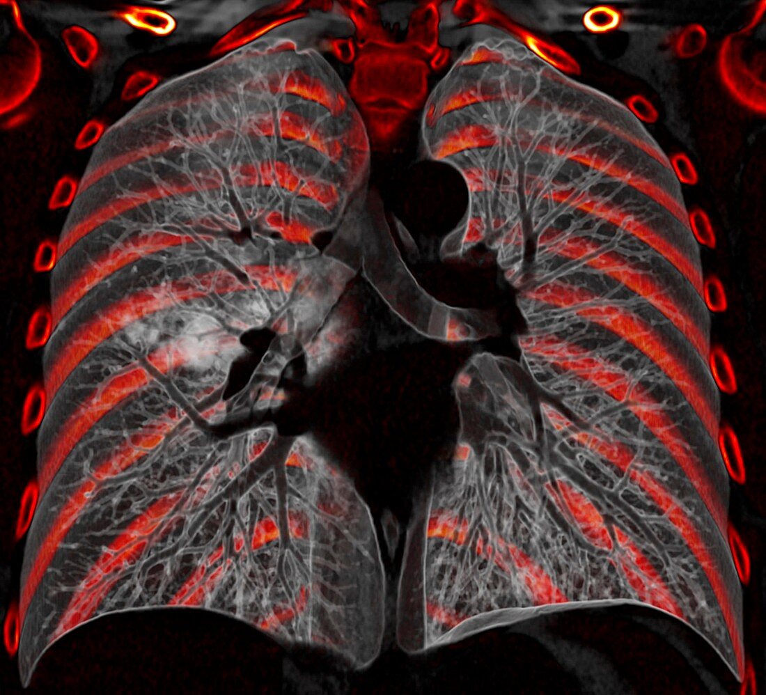 Lungs affected by Covid-19 pneumonia, CT scan