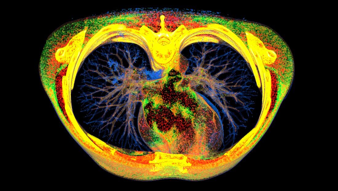 Lungs affected by Covid-19 pneumonia, CT scan