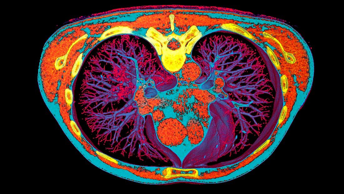 Lungs affected by Covid-19 pneumonia, CT scan