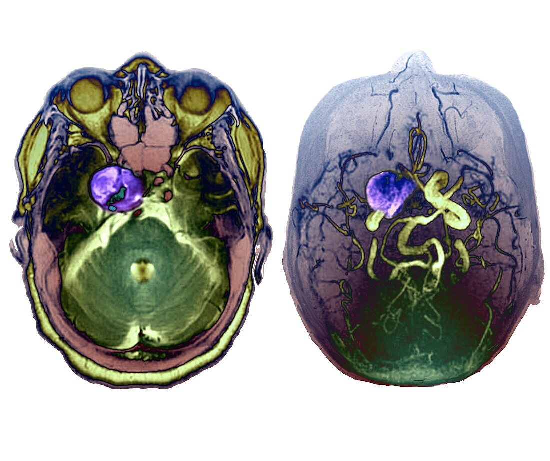 Subarachnoid haemorrhage, MRI angiogram