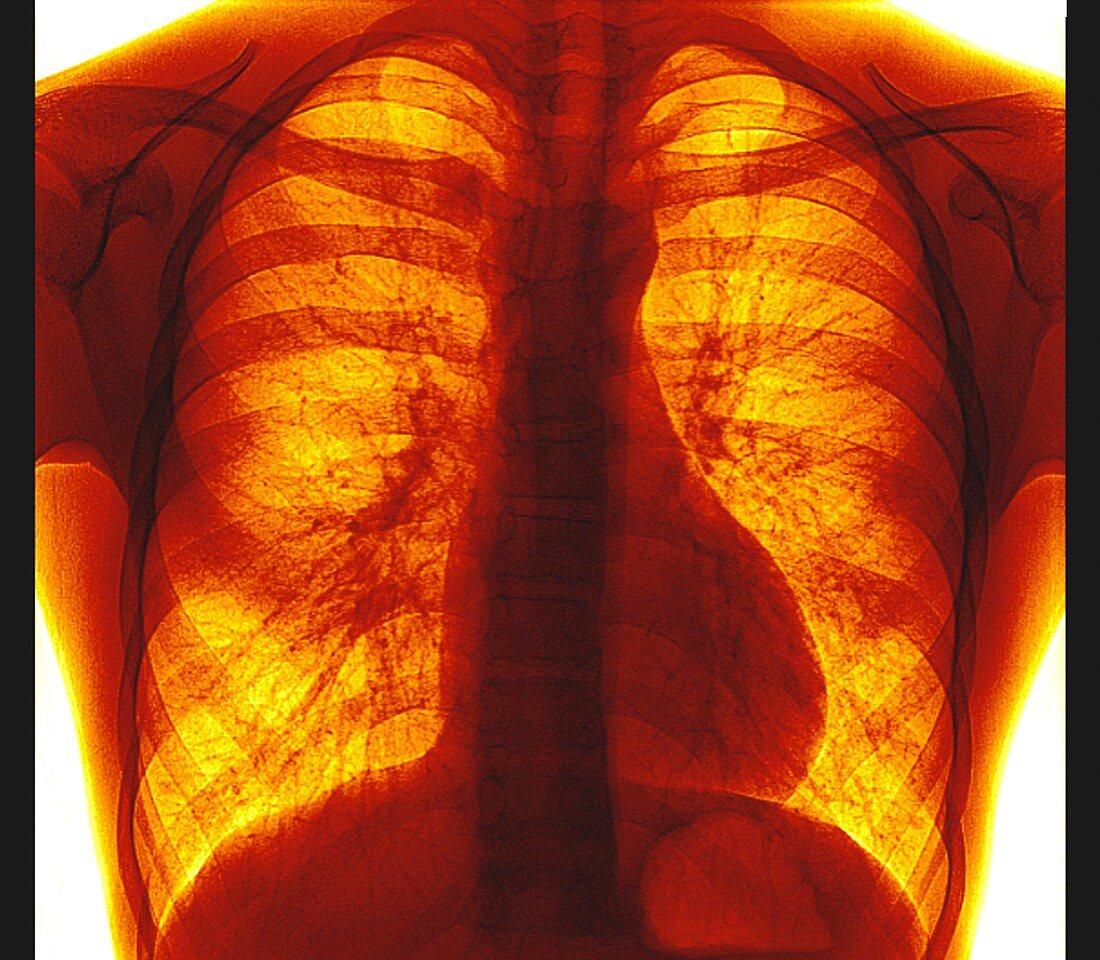 Healthy lungs, X-ray