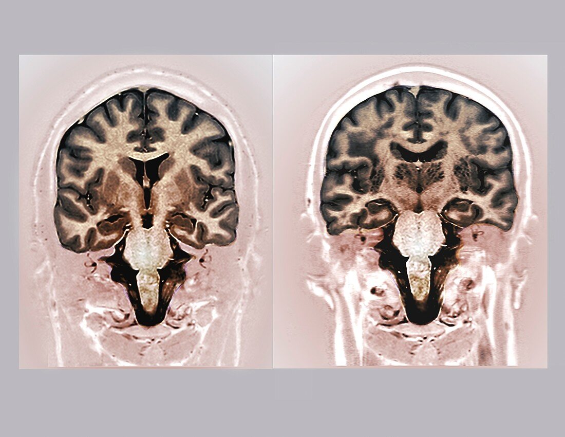 Young and old brians, MRI scans