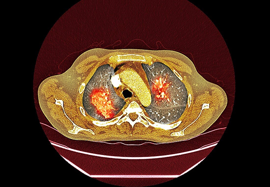 Lungs affected by Covid-19 pneumonia, CT scan