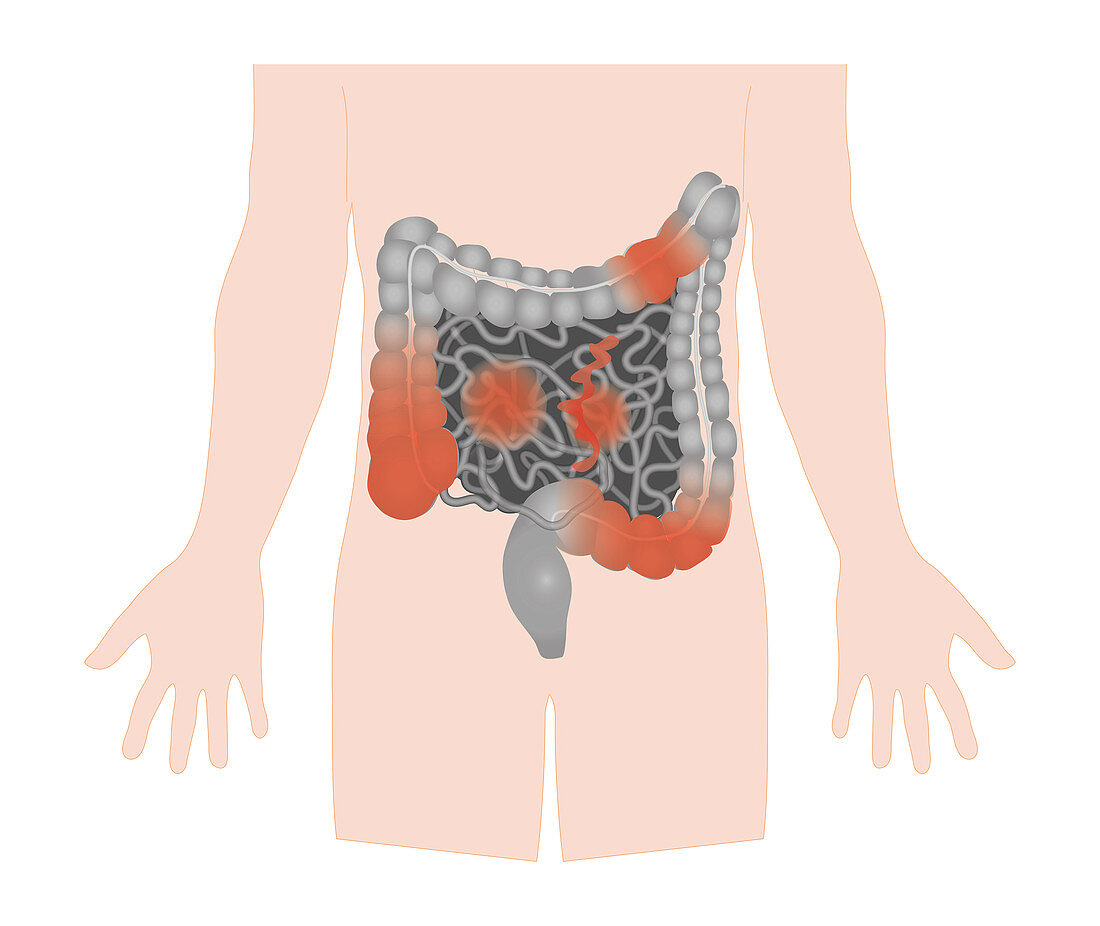 Crohn's disease, illustration