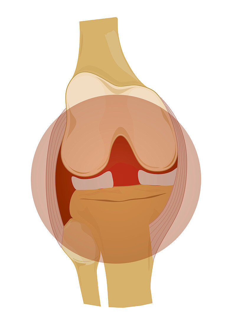 Arthritic knee, illustration