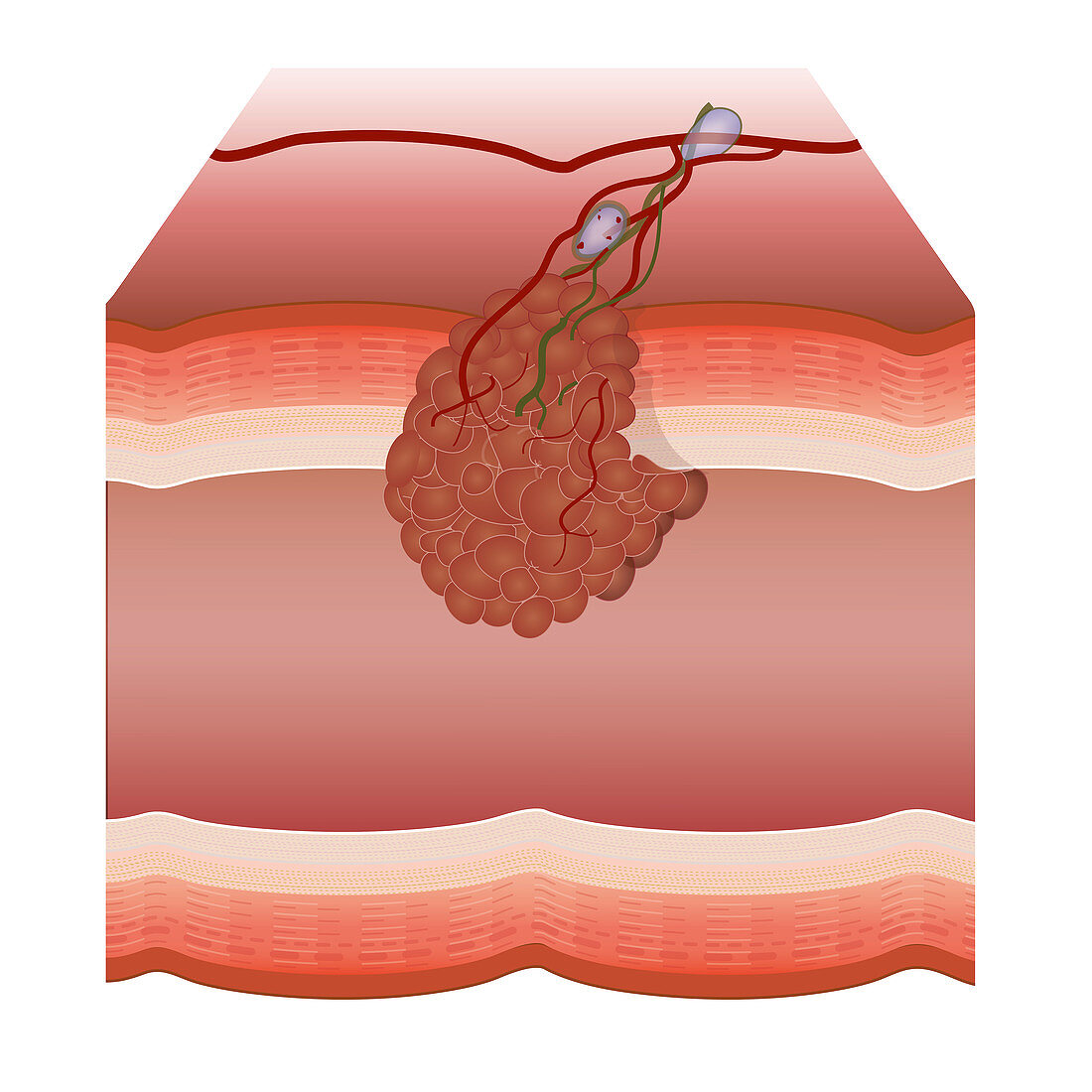 Tumour, illustration