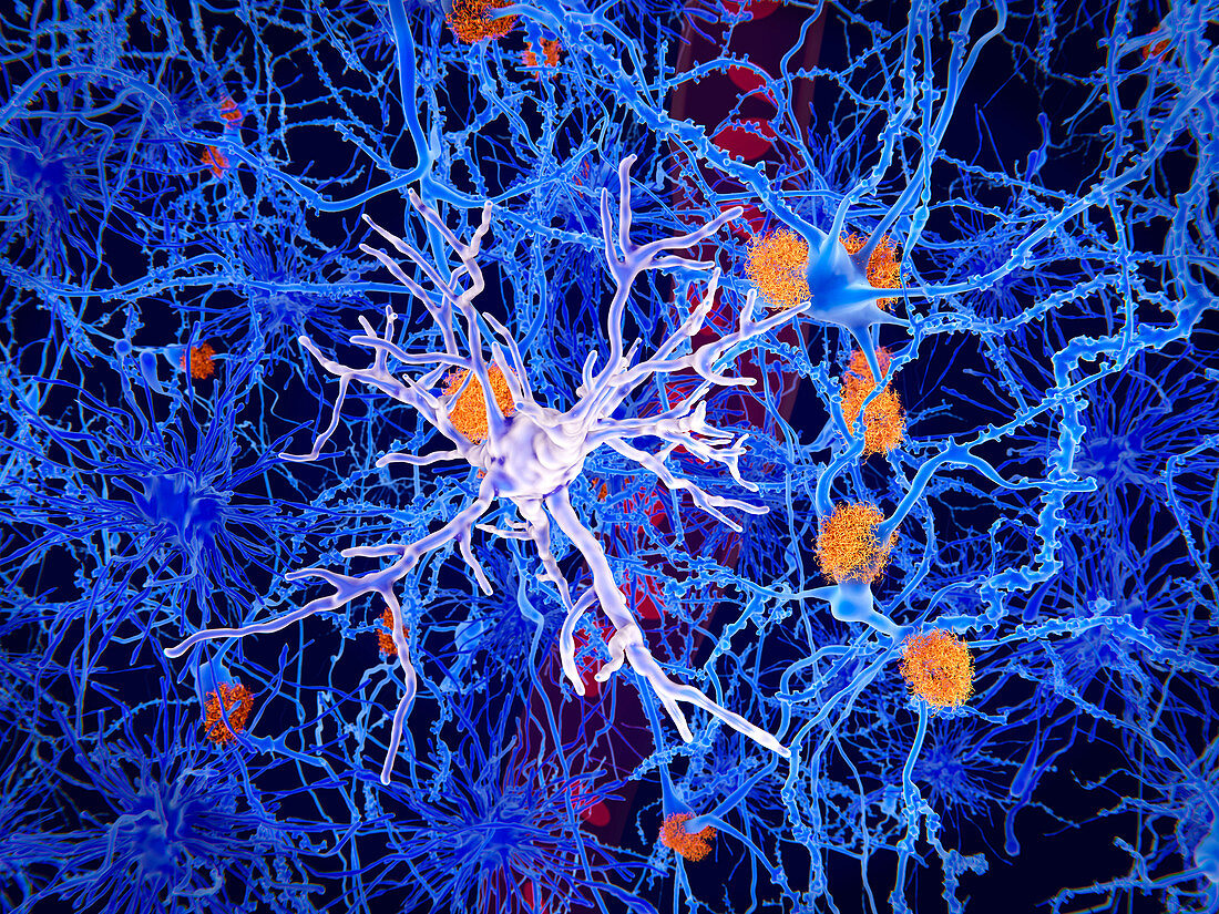 Amyloid and microglia cell in Alzheimer's, illustration