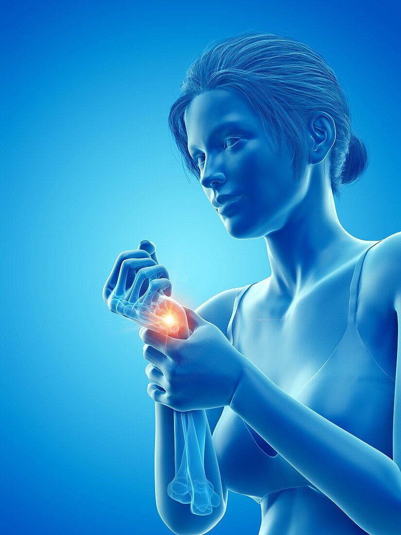 Woman with a painful wrist, illustration