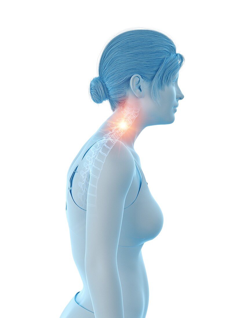 Woman with a painful neck, illustration