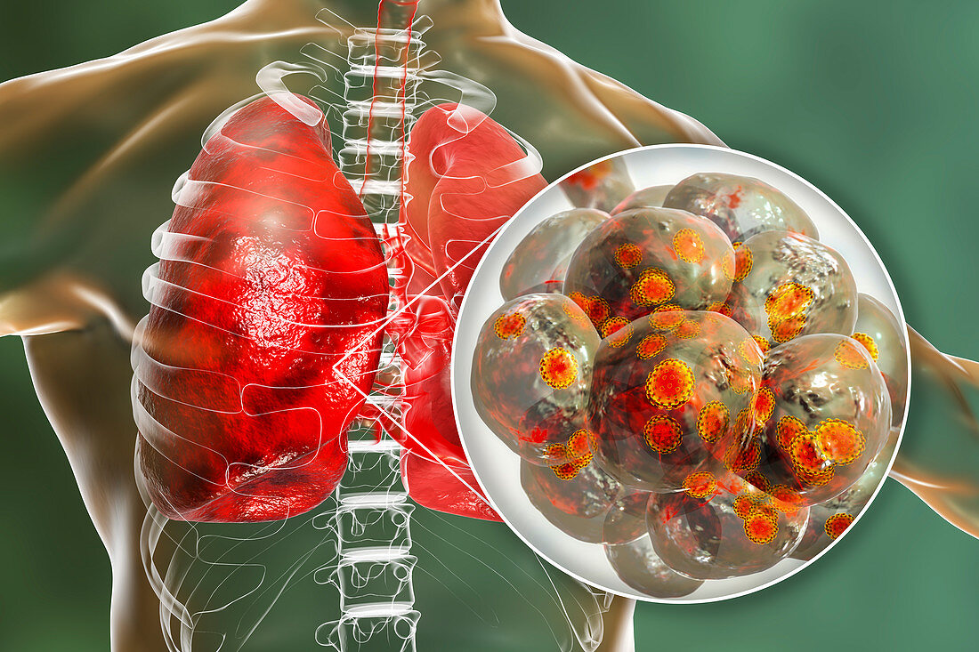 Coronavirus disease of the lungs, conceptual illustration