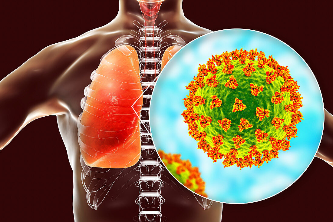 Coronavirus disease of the lungs, conceptual illustration