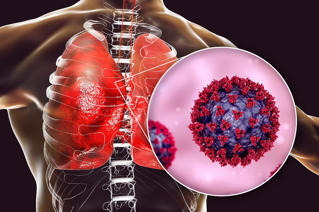 Coronavirus disease of the lungs, conceptual illustration