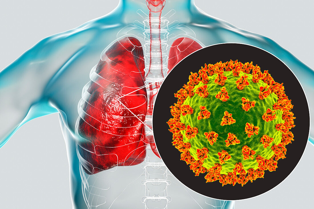 Coronavirus disease of the lungs, conceptual illustration